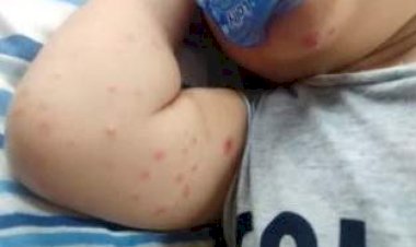 Síndrome mão-pé-boca. Saiba o que fazer e quais os cuidados