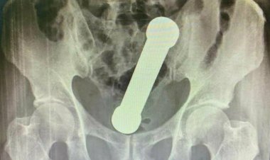 Médicos retiram peso de academia de dentro de paciente de Manaus