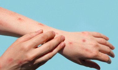 SP confirma segundo caso de varíola dos macacos no Brasil