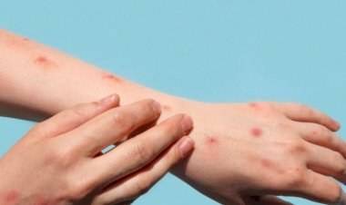 Amazonas tem primeiro caso suspeito de ‘varíola do macaco’; material do paciente foi coletado e é investigado