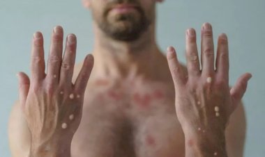 Paciente com sintomas de varíola dos macacos esteve em Parintins, diz FVS-AM