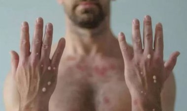 Amazonas confirma primeiro caso de varíola dos macacos