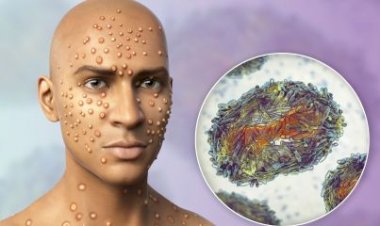 Ministério da Saúde passa a tratar varíola dos macacos como surto; Brasil tem mais de mil casos