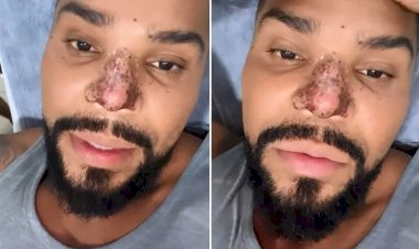 Entenda os riscos da rinomodelação, procedimento que causou necrose no nariz do cantor Naldo