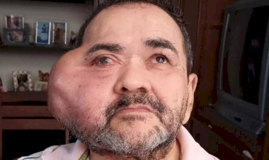 Marceneiro luta na Justiça para tirar tumor gigante: '18 doses de morfina por dia'