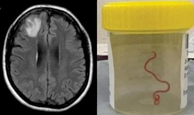 Verme de 8 cm é encontrado em cérebro humano pela primeira vez