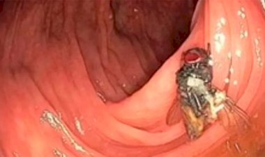 Mosca é encontrada viva em intestino de paciente; entenda o caso