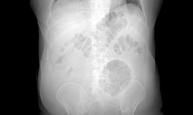 Hospital no Rio identifica caso de doença raríssima, com menos de 200 casos no mundo