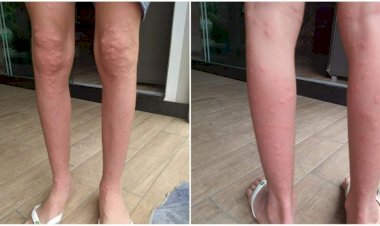 Conheça o maruim, inseto que levou cidade de SC a decretar emergência