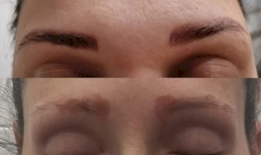 Mulheres ficam com lesões no pulmão após procedimento na sobrancelha