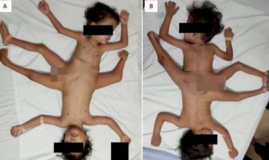 Gêmeos ligados pela pelve e com três pernas não podem ser separados