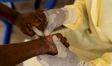 “Mpox não é a nova Covid”, diz diretor da Organização Mundial da Saúde