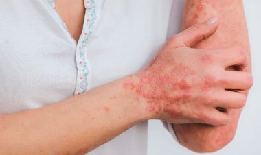 Mais de mil casos de esporotricose humana são confirmados no Amazonas em 2024