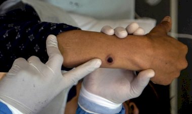 Mpox: SP confirma primeiro caso brasileiro de nova cepa responsável por surto na África