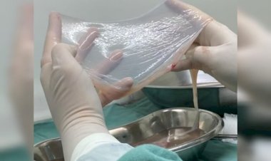 SUS usará membrana retirada no parto para tratar queimaduras. Entenda