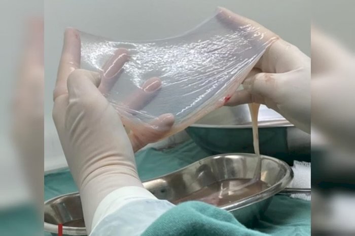 SUS usará membrana retirada no parto para tratar queimaduras. Entenda