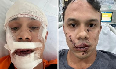 Personal leva 45 pontos no rosto ao defender mulheres de assédio e ser agredido com copo de vidro em bar de SP