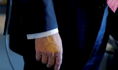 Trump recebe diagnóstico de insuficiência venosa após inchaço nas pernas