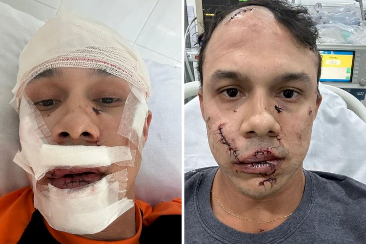 Personal leva 45 pontos no rosto ao defender mulheres de assédio e ser agredido com copo de vidro em bar de SP