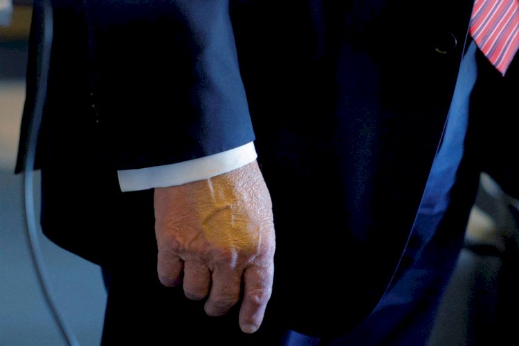 Trump recebe diagnóstico de insuficiência venosa após inchaço nas pernas