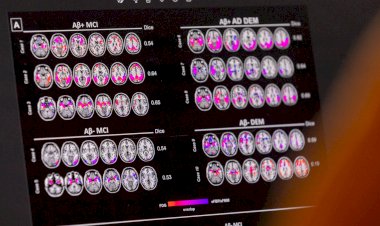 Novo tratamento para Alzheimer inicial começa a ser disponibilizado no Brasil
