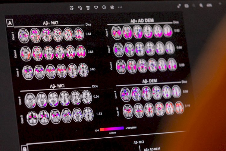 Novo tratamento para Alzheimer inicial começa a ser disponibilizado no Brasil