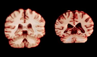 Cérebro de homens e mulheres encolhe a velocidades diferentes. Estudo analisou como isso impacta Alzheimer