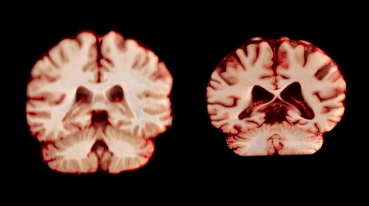 Cérebro de homens e mulheres encolhe a velocidades diferentes. Estudo analisou como isso impacta Alzheimer
