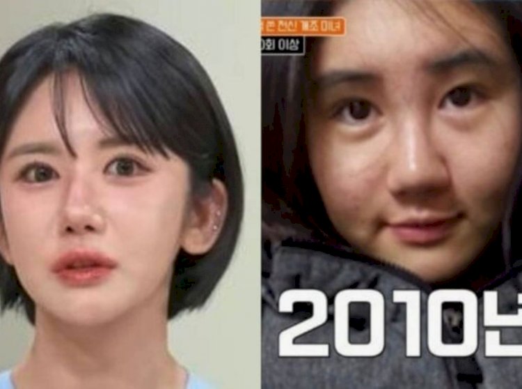 Transformação impressionante: sul-coreana gasta mais de R$ 1 milhão em cirurgias plásticas