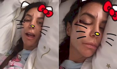 Ivete Sangalo: cantora revela que sofreu queda após uma 'infecção intestinal bem violenta'; entenda a condição