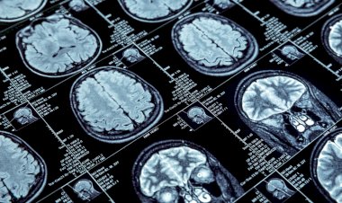 Remédio para Alzheimer em estágio inicial custará de R$ 8.000 a R$ 11 mil