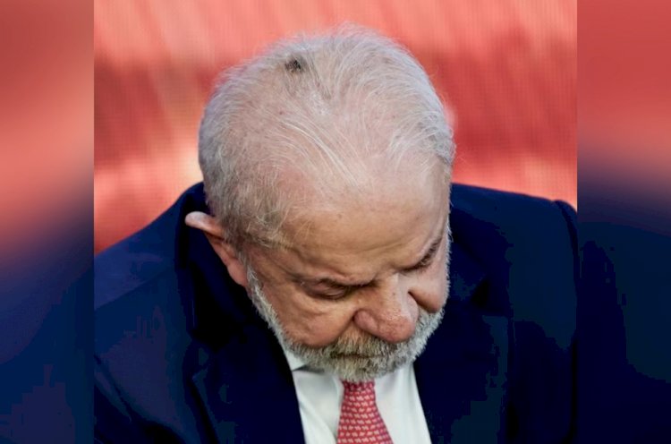Lula tira lesão de pele no couro cabeludo e tem alta para casa