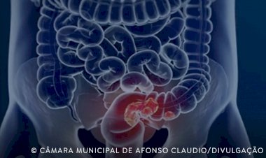 SUS adota novo exame para rastrear câncer colorretal na população