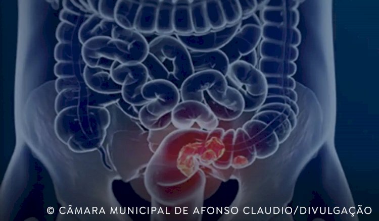 SUS adota novo exame para rastrear câncer colorretal na população